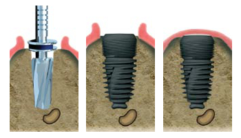 Spécialiste implant dentaire Sannois