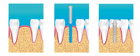 Implants dentaires Sannois